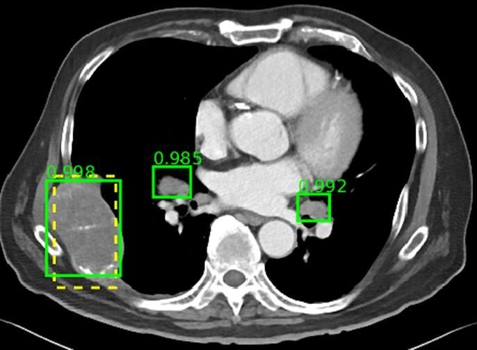 Impacto de la Inteligencia Artificial en la Radiología